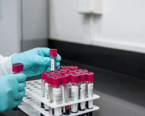 Senior die bloeduitslag bekijkt met HDL-cholesterol waarden op papier